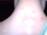 Neck Eczema After
