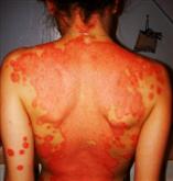 psoriasis before