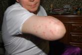 elbow psoriasis before